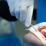 Root Canals Vs. Tooth Extractions – Which Is Better?